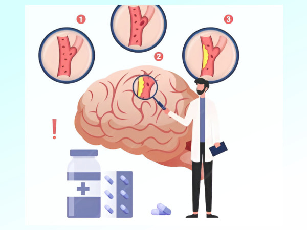 Isquemia Cerebral sintomas y tipos de accidente cerebrovascular